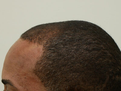 Hair Restoration
