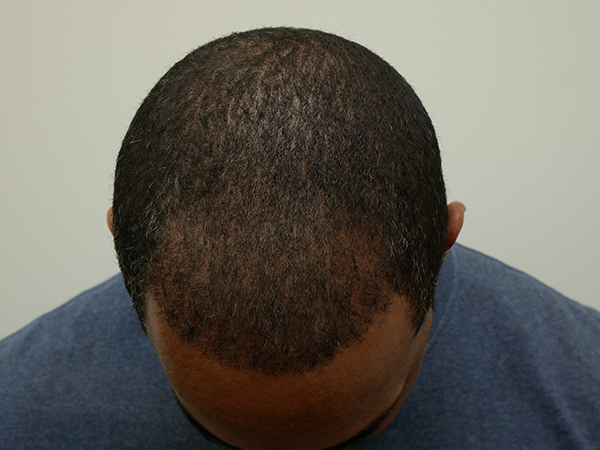 Hair Restoration