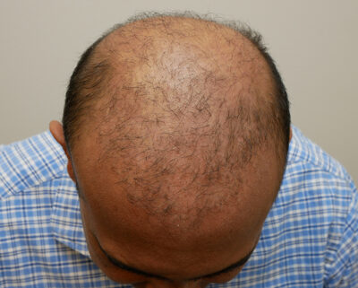 Hair Restoration