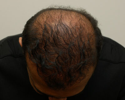 Hair Restoration