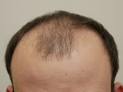 Hair Restoration