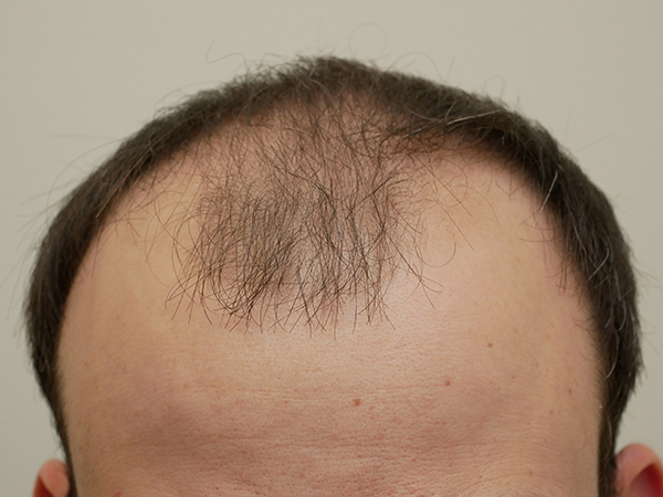 Hair Restoration