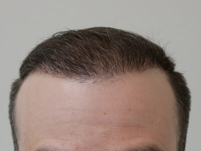 Hair Restoration