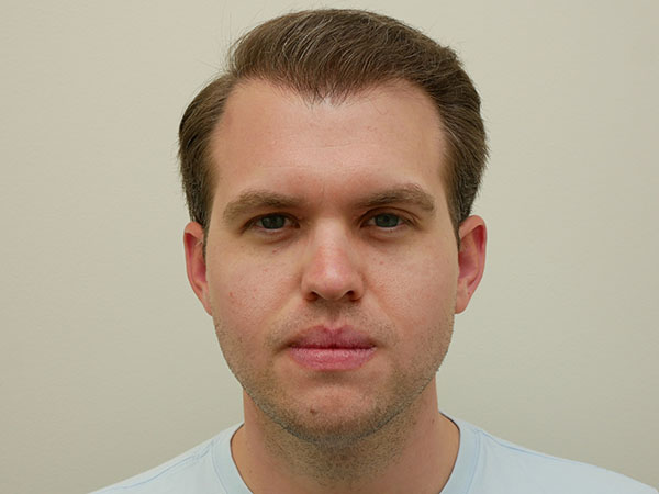 Hair Restoration