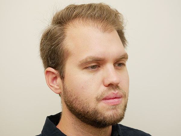 Hair Restoration
