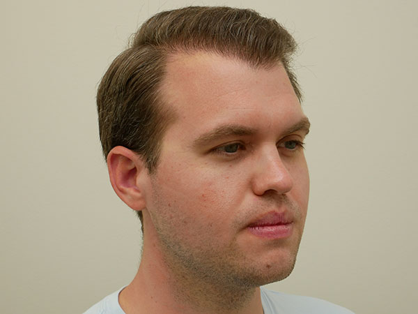 Hair Restoration