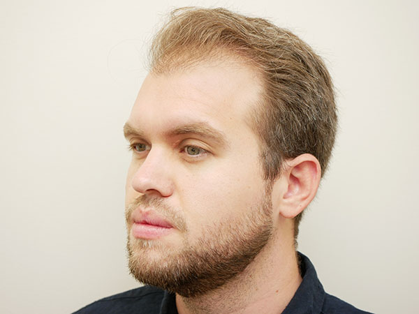 Hair Restoration