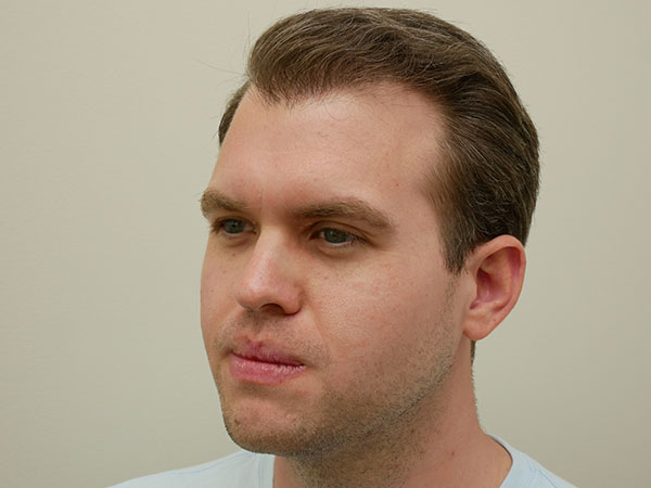 Hair Restoration