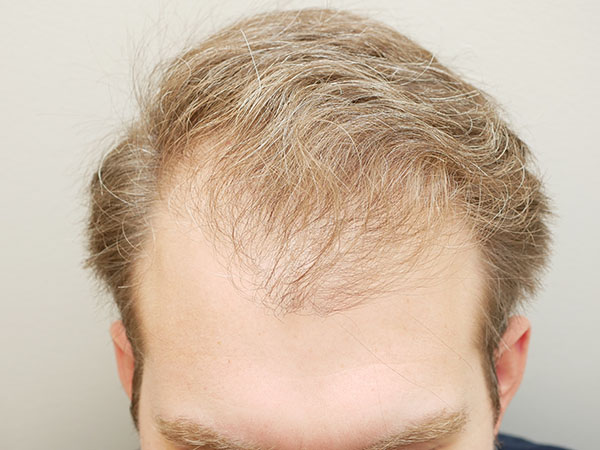 Hair Restoration
