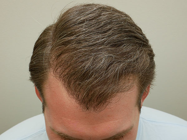 Hair Restoration