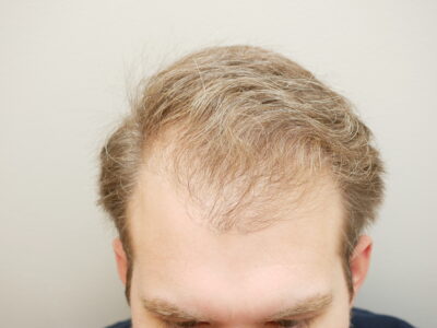 Hair Restoration