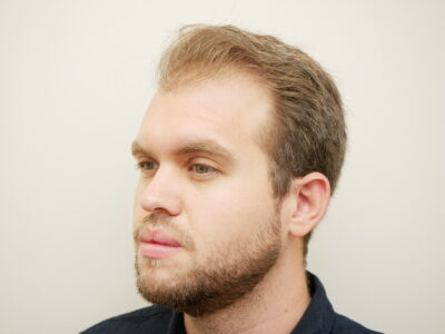 Hair Restoration