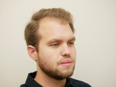 Hair Restoration