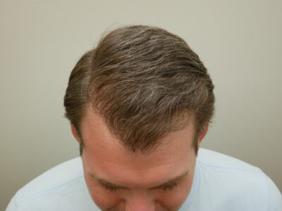 Hair Restoration