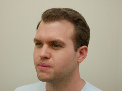 Hair Restoration