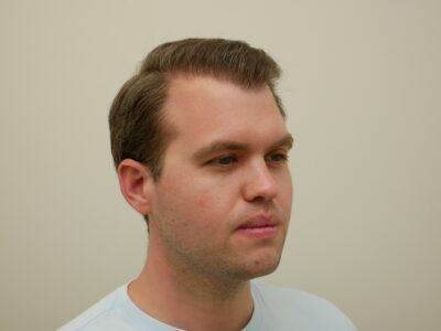 Hair Restoration