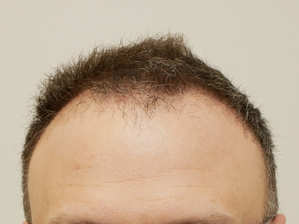 Hair Restoration