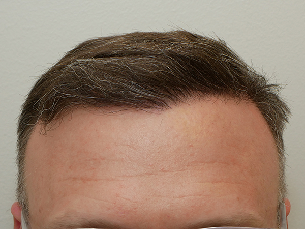 Hair Restoration