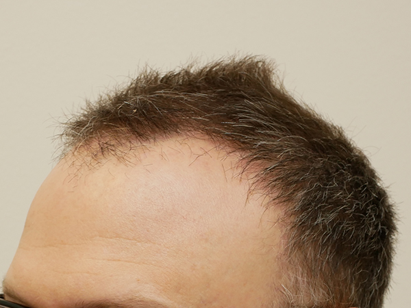 Hair Restoration