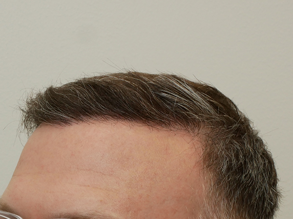 Hair Restoration