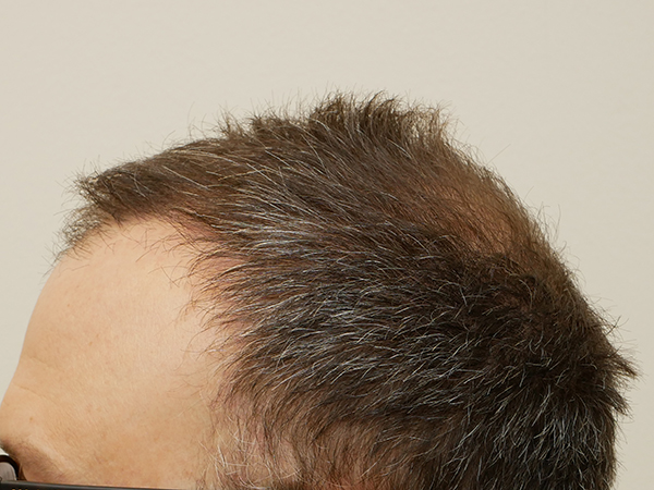 Hair Restoration