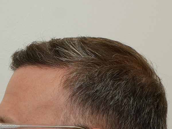 Hair Restoration