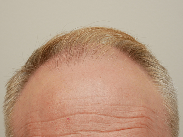 Hair Restoration
