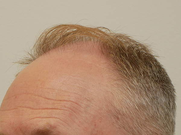 Hair Restoration