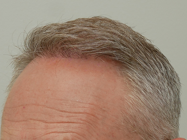 Hair Restoration