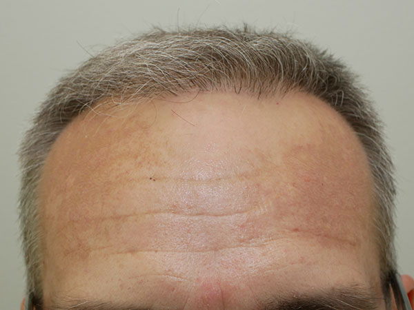 Hair Restoration