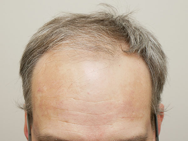 Hair Restoration
