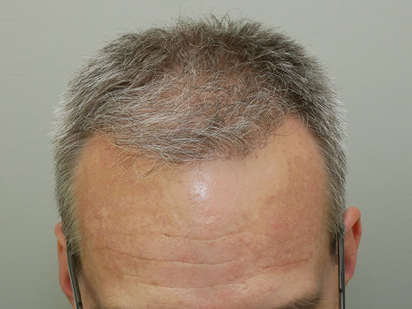 Hair Restoration