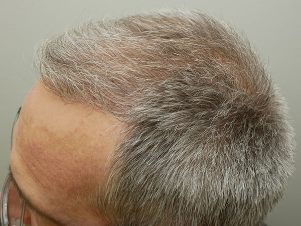 Hair Restoration