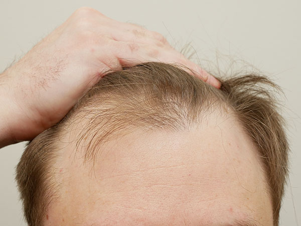 Hair Restoration