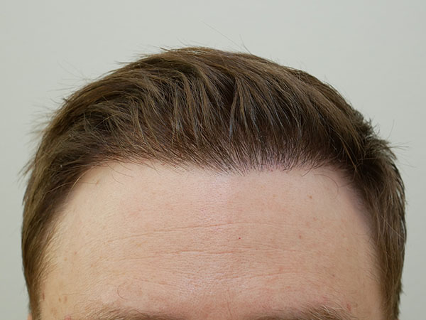 Hair Restoration