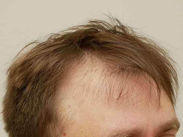 Hair Restoration