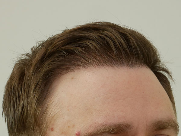 Hair Restoration