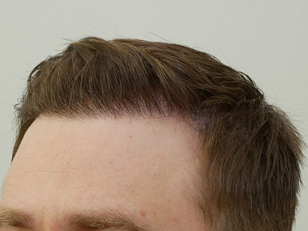Hair Restoration