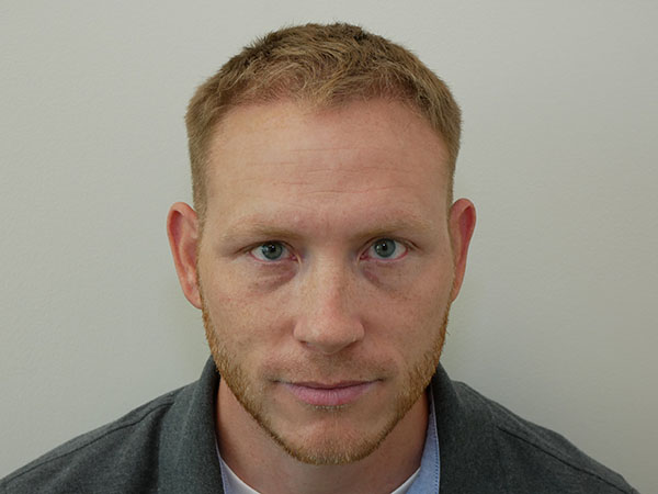 Hair Restoration
