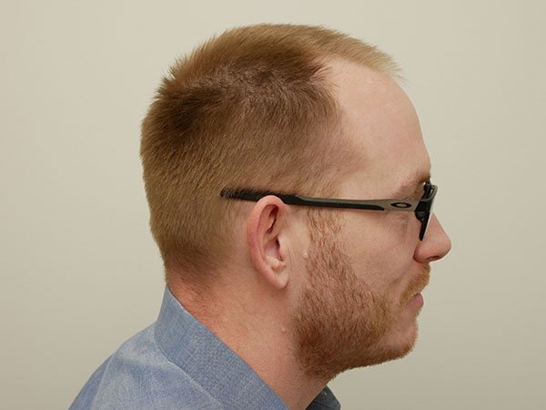 Hair Restoration