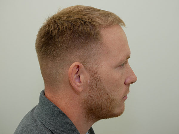 Hair Restoration