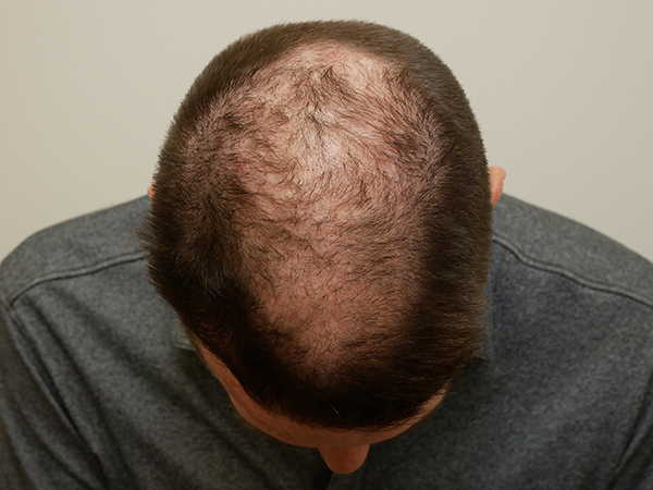 Hair Restoration