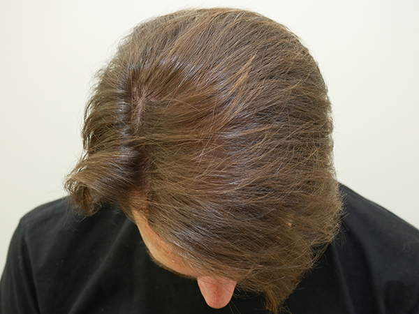 Hair Restoration
