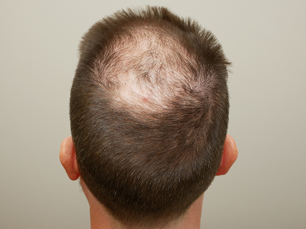 Hair Restoration