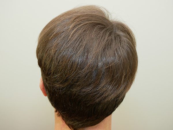 Hair Restoration