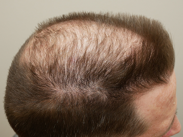 Hair Restoration