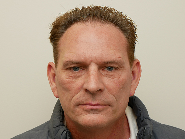 Hair Restoration