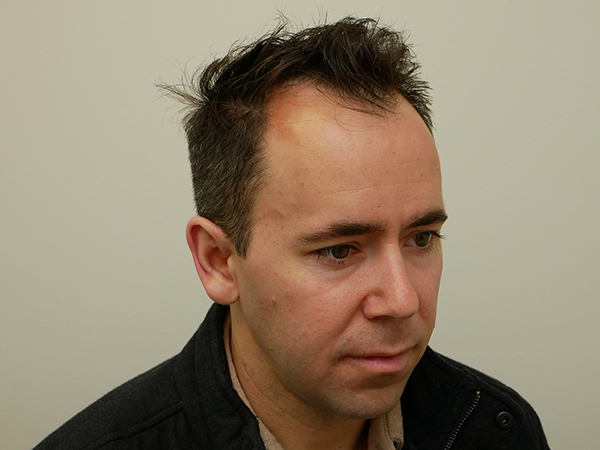 Hair Restoration