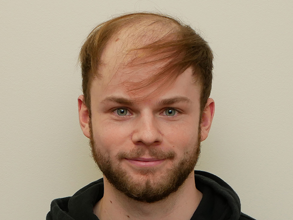 Hair Restoration