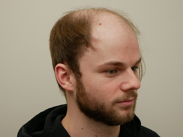Hair Restoration